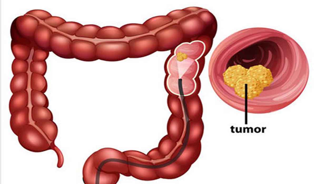 Care sunt simptomele cancerului de colon