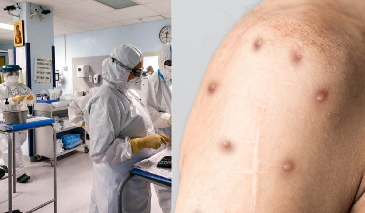 A fost confirmat al doilea caz de variola maimutei in Romania!