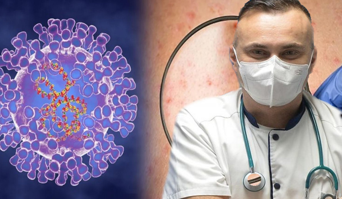 Medicul Adrian Marinescu a facut anuntul. Simptomele variolei maimutei inainte de eruptia pe piele.